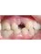 Dental Integral - SINGLE IMPLANT BEFORE CROWN 