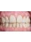 Dental Integral - full porcelain crowns 