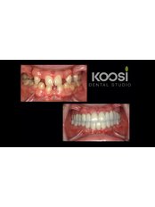 PFM Crown - Koosi Dental Studio