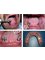 Koosi Dental Studio - Full Denture Over Implants 