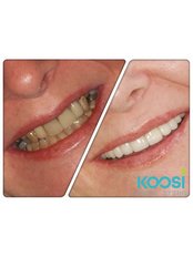 Porcelain Crown - Koosi Dental Studio