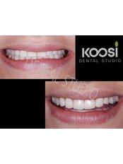 Porcelain Veneers - Koosi Dental Studio