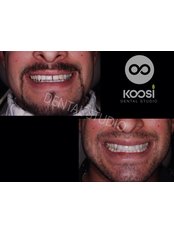 Lumineers™ - Koosi Dental Studio