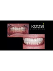 Zirconia Crown - Koosi Dental Studio