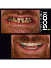Restoration of Implants - Koosi Dental Studio