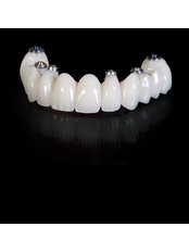 Implant Bridge - Dental Cosmetics
