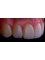 Dental Practice - Rocky Point - Composite Veneers  