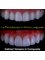 Dental Practice - Rocky Point - Before and after composite veneer indirect 