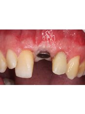 Dental Implants - Clínica Dental Plaza Marina