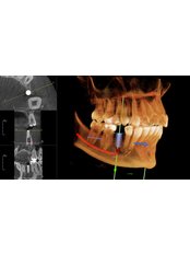 3D Dental X-Ray - Dentoamerica - Puerto Vallarta