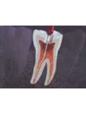 Endodontist Consultation - International Dental Center PV