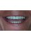 International Dental Center PV - Aesthetic Dentistry upper crowns 