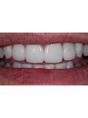Veneers - PV Smile Dental Clinic