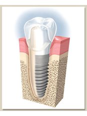 Dental Implants - PV Smile Dental Clinic