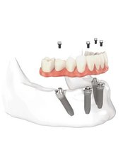 Dentures - PV Smile Dental Clinic
