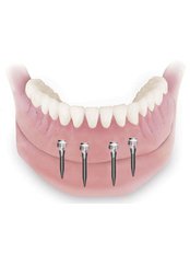 Mini Implants - PV Smile Dental Clinic