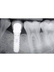 Dental Implants - Bio Dental Clinic