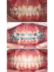 Orthodontics - Dentista en reynosa