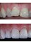 Advanced Smiles Dentistry Tijuana - Before and After 