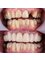 Aesthetic Smiles Studio - Full Mouth Restoration 
