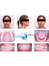 Orthodontics (Braces) - Clínica Dental Unión
