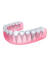 Dental Implants - Clínica Dental Unión