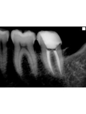 Endodontist Consultation - Clínica Dental Unión