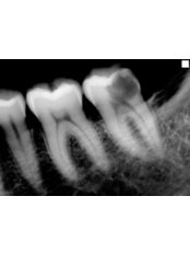 Endodontist Consultation - Clínica Dental Unión