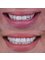 Dental 32 - Before/after porcelain Veneers 