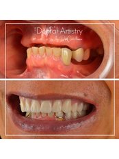All-on-4 Dental Implants - Dental Artistry by Dr Castellanos