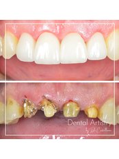 Dental Crowns - Dental Artistry by Dr Castellanos