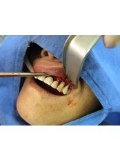 Periodontitis Treatment - Dentic Dental