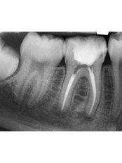Molar Root Canal - Dentic Dental