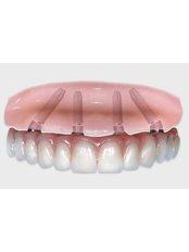 All-on-4 Dental Implants - Downtown Dental Tijuana