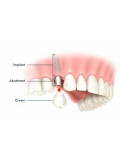 Single Dental Implant (Implant, Abutment, Crown) - Downtown Dental Tijuana