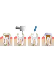Root Canals - Dr. Flor G. Wing