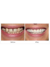 Dental Crowns - Dr. Flor G. Wing