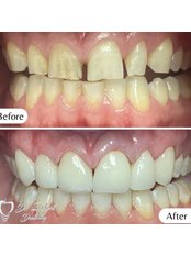 Zirconia Crown - Dr. Implant Dentistry