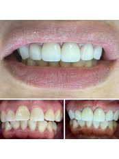 EMAX Dental Crowns - Dr. Implant Dentistry