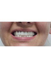 Full Mouth Rehabilitation - Funesmile Dental Clinic