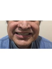 All-on-4 Dental Implants - Funesmile Dental Clinic