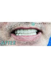 All-on-6 Dental Implants - Funesmile Dental Clinic