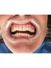 Dental Implants - Funesmile Dental Clinic