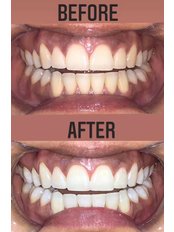 Teeth Whitening - Improve Dent