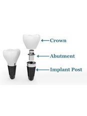 Dental Implants - Liberty Dental Clinic