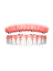 All-on-4 Dental Implants - Liberty Dental Clinic
