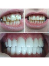 Smile Makeover - Liberty Dental Clinic
