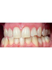 Teeth Cleaning - Muela Dental