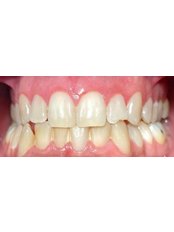 Teeth Cleaning - Muela Dental