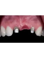 Dental Implants - Natural Dental Center